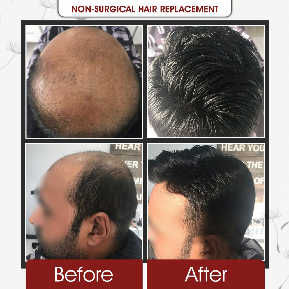Natural looking hair replacement results at Grace Follicles