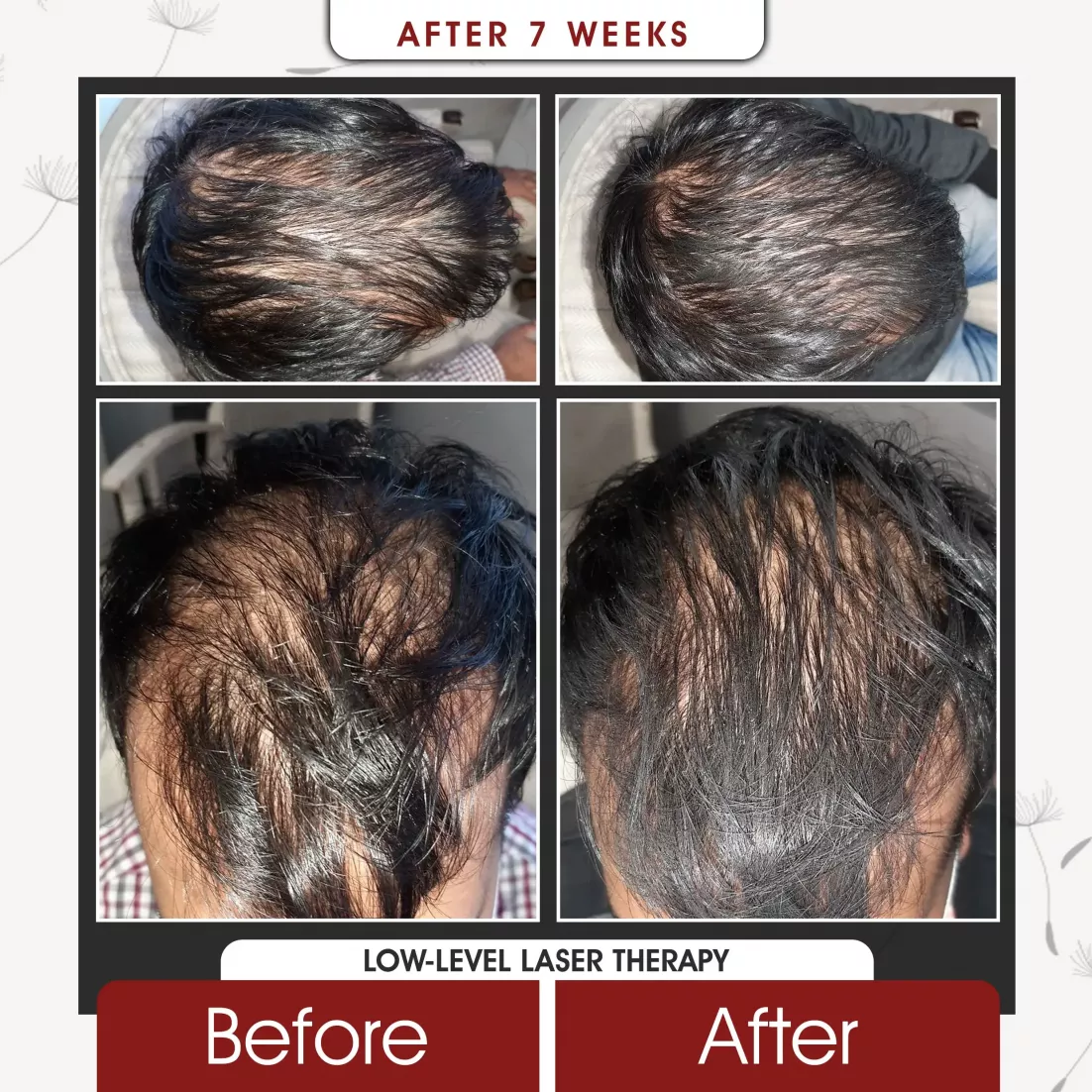 Low Level Laser Therapy After 7 Weeks