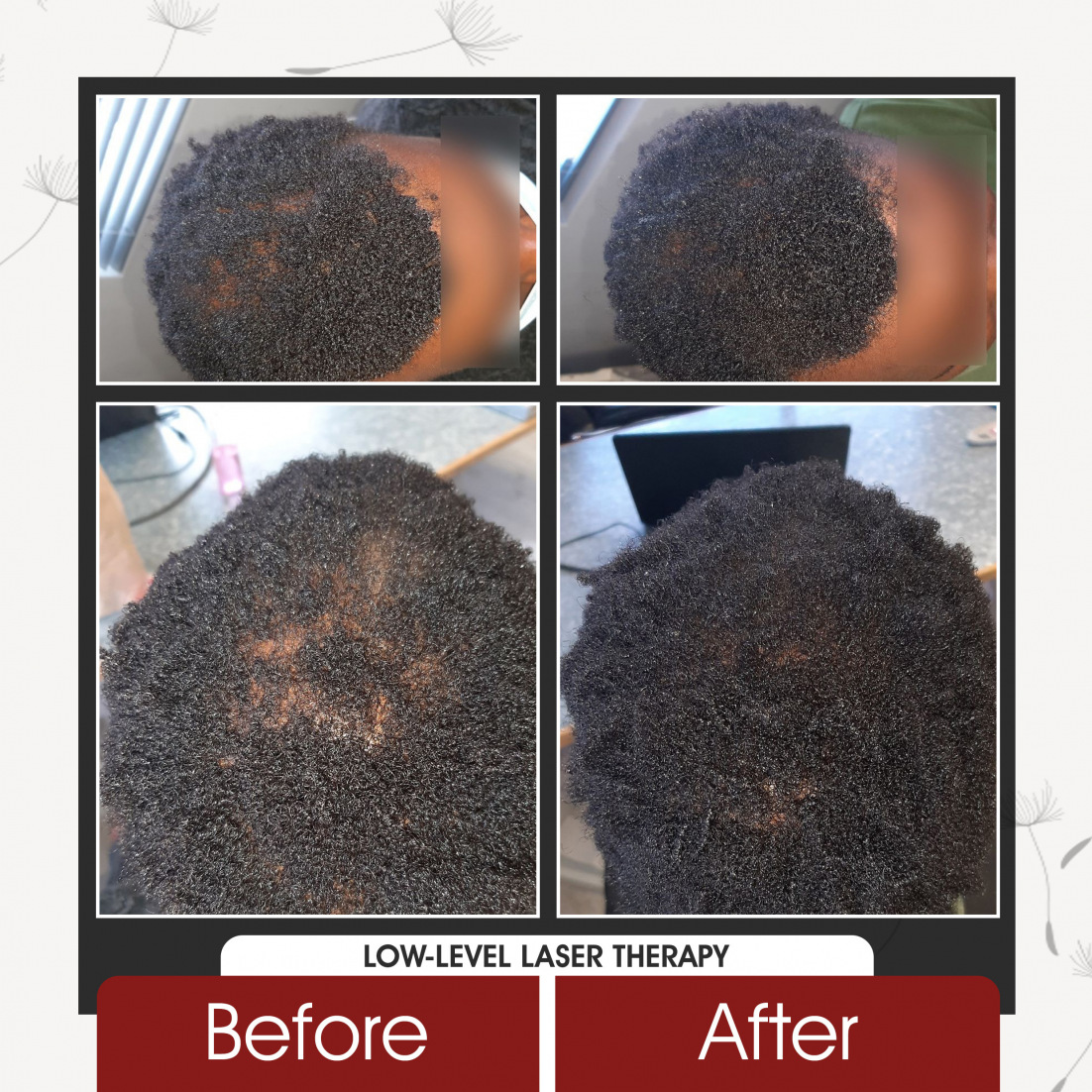 Low Level Laser Therapy