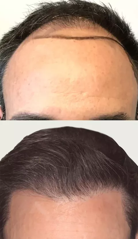 Follicular Unit Extraction hair restoration procedure