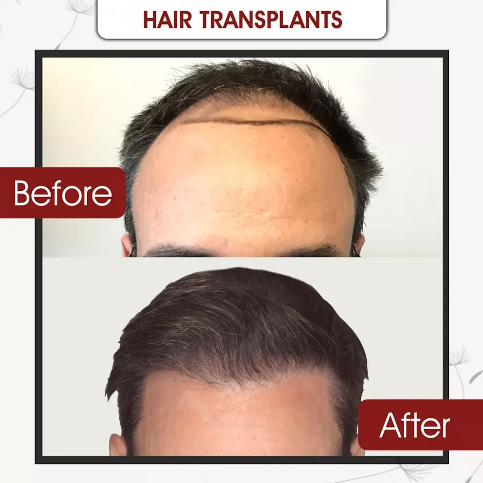 Follicular Unit Extraction hair transplant clinic in South Africa
