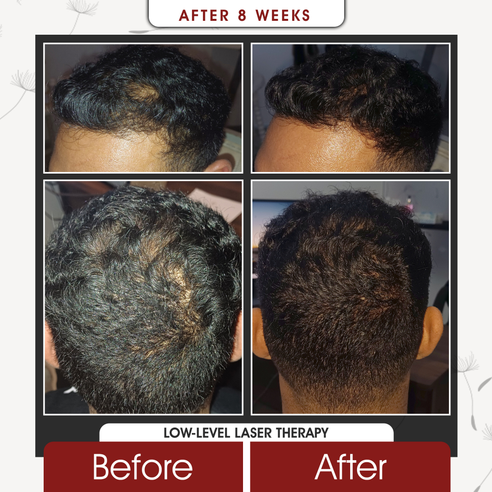 Before and after low level laser therapy for hair loss at Grace Follicles