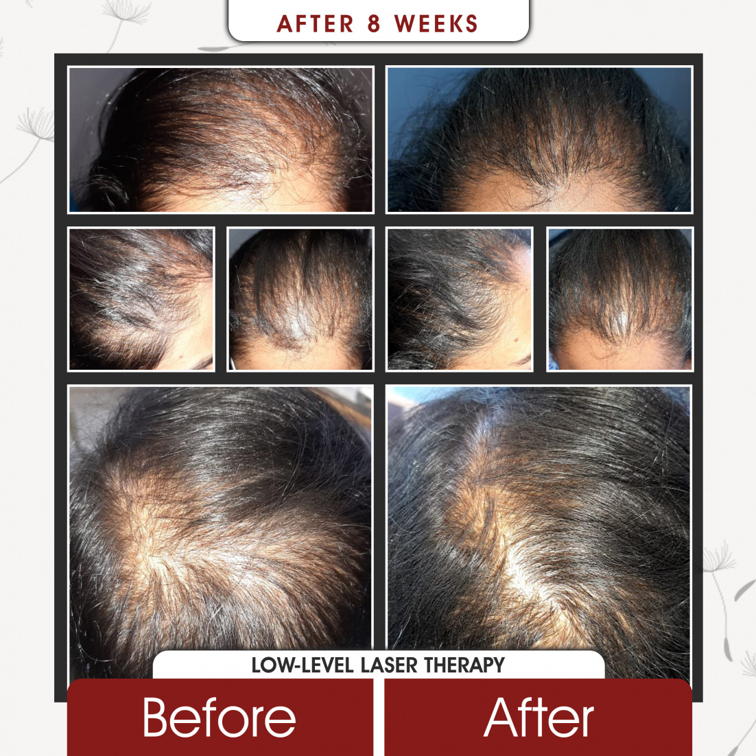 Low Level Laser Therapy After 8 Weeks