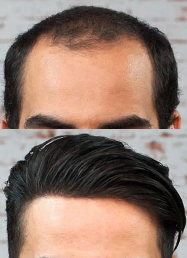 Custom non-surgical hair replacement system